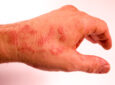 linke Hand mit Neurodermitis-Anzeichen