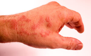 linke Hand mit Neurodermitis-Anzeichen